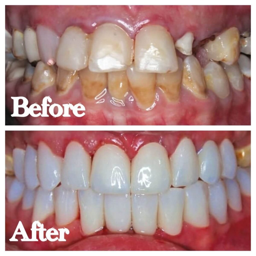 ابتسامة هوليود قبل وبعد - Hollywood smile and teeth bleaching before and after.