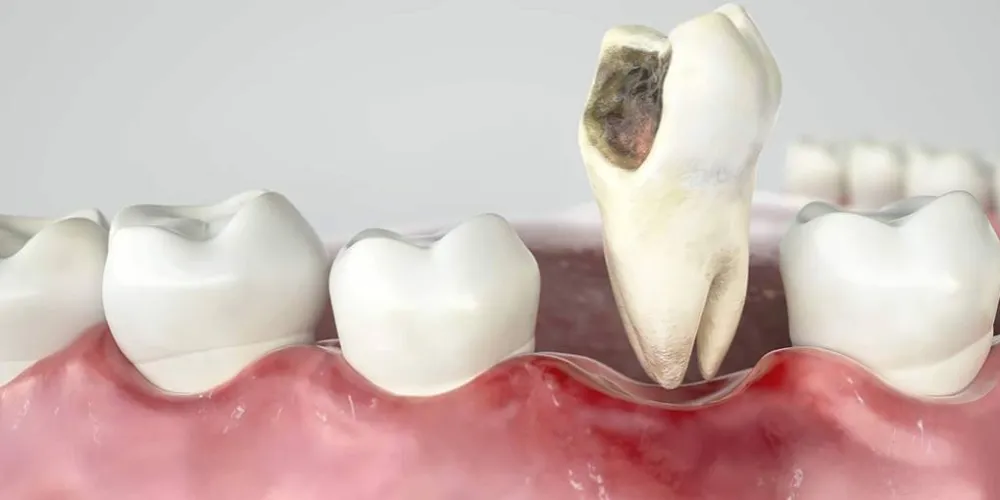 Important Tips After Tooth Extraction