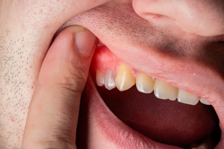 شكل الخراج في الضرس – الأعراض والأسباب والعلاج