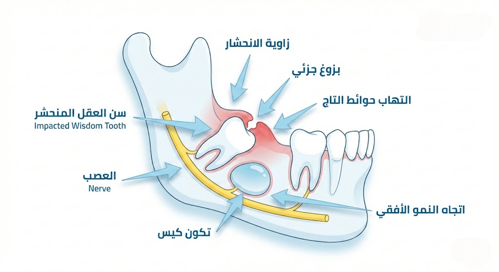 مخطط تشريحي يوضح ضرس العقل المدفون أفقيًا في الفك السفلي والمشاكل المصاحبة له مثل التهاب اللثة، ضغط العصب، وتكون الأكياس المرضية.