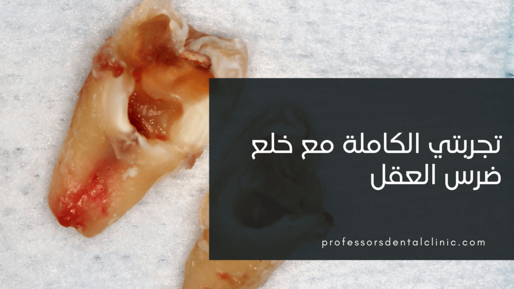 تجربتي مع خلع ضرس العقل – أسهل بكتير مما تخيلت