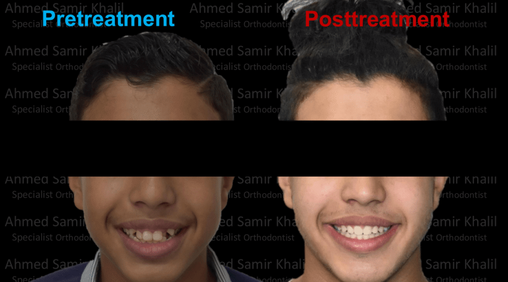 Case #1 - قبل وبعد تقويم الأسنان