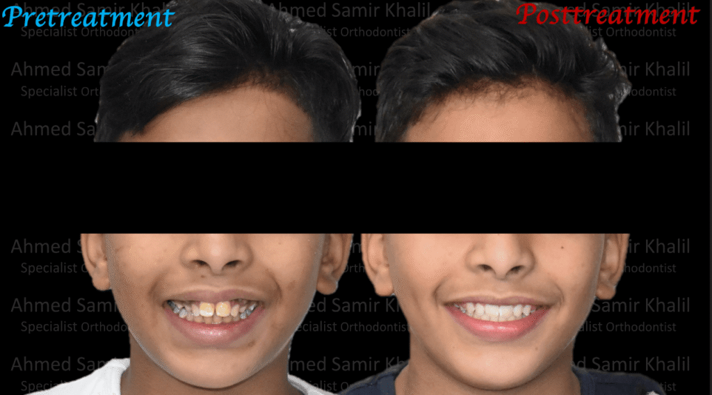 Case #2 - قبل وبعد تقويم الأسنان