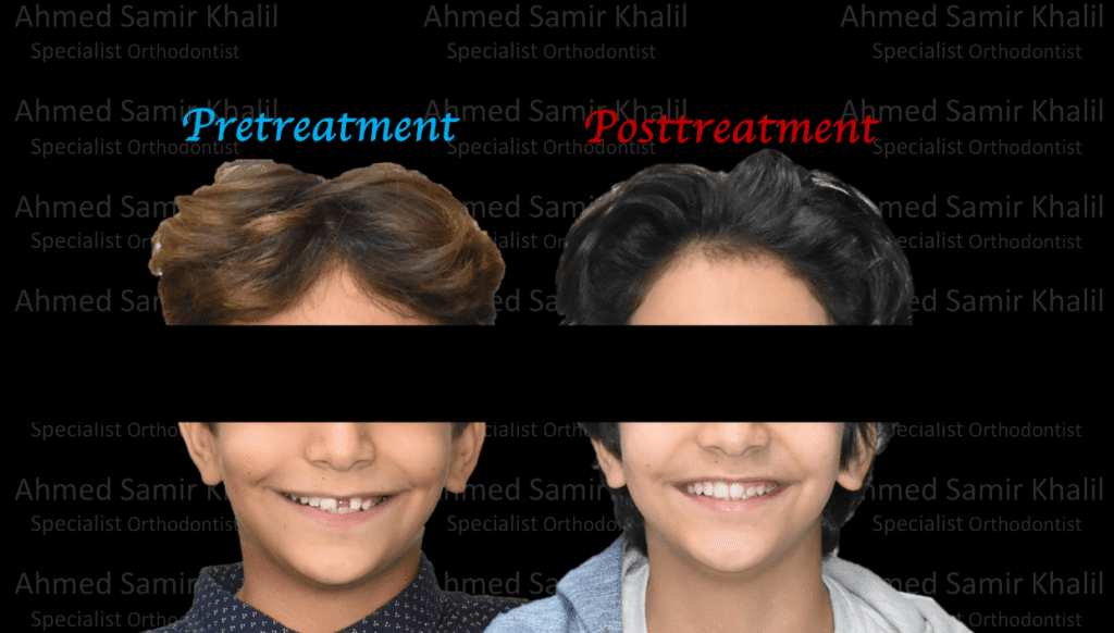 Case #3 - قبل وبعد تقويم الأسنان