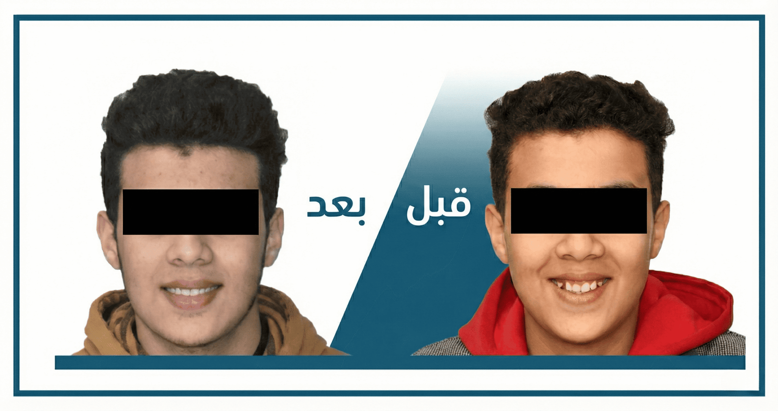 تقويم الأسنان قبل وبعد: نتائج حقيقية من عيادتنا