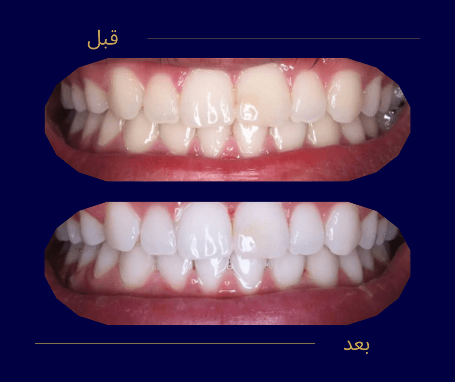 تجربتي مع تبييض الأسنان بالليزر – قصص نجاح حقيقية